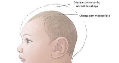 8400,brasil-tem-399-casos-de-microcefalia-zika-virus-pode-ser-a-causa-2