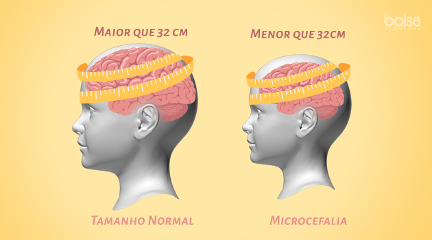 microcefalia_0